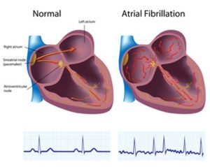 Normal heart vs. heart with atrial fribillation.